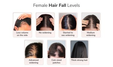 Traya's Study Reveals a Concerning Finding: One in Two Women Aged 36-40 Suffer from Advanced Widening or Female Pattern Hair Loss